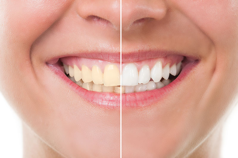 Teeth Whitening in Overland Park